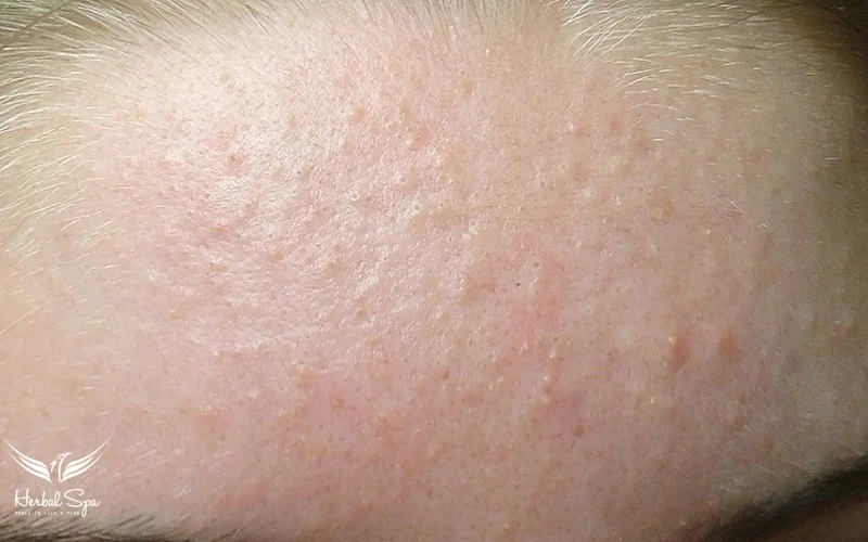 炎症を伴う腫れた赤いニキビ