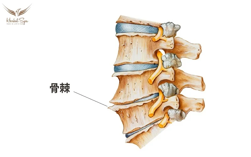 椎間板の変性は骨棘を形成することにつながる