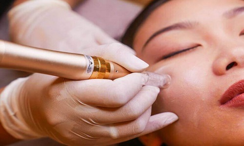 다낭 얼굴 관리: 자연 추출물을 활용하여 여드름 피부를 정화하는 방법.
